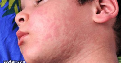 Hives
