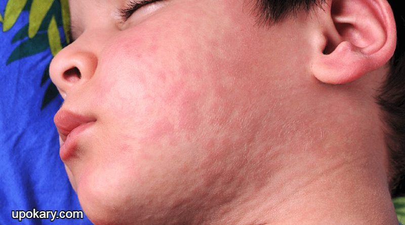 Hives