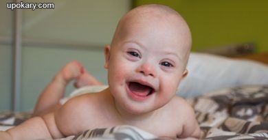 Down_syndrome