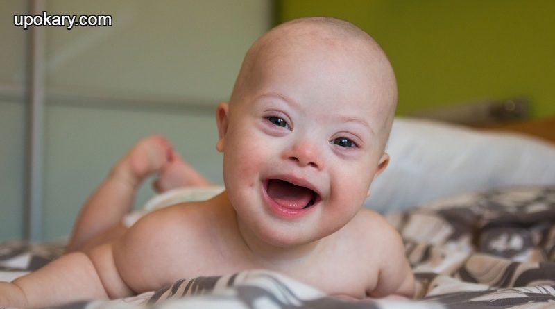 Down_syndrome