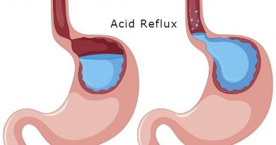 gerd diagram