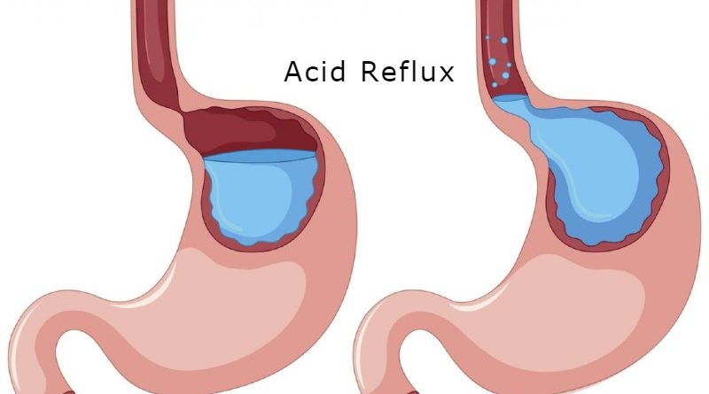 gerd diagram